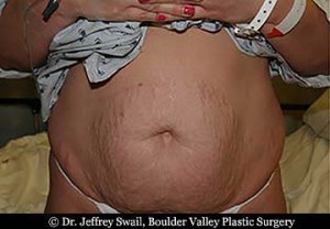 Umbilical Hernia Surgery NJ  Belly Button Hernia Surgery in New Jersey