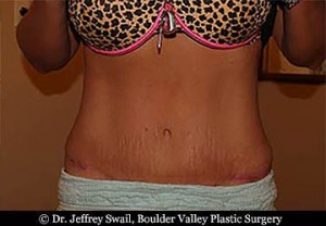 Umbilical Hernia - Boulder Valley Plastic Surgery