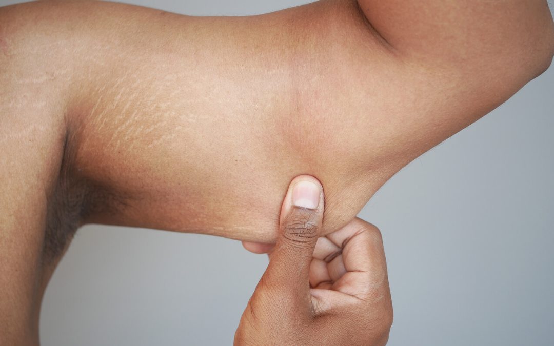 Arm Lift Surgery (Brachioplasty): The Secret to Toned Upper Arms