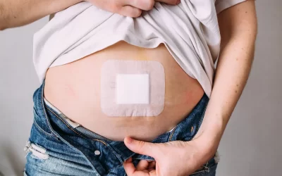 What to Expect After Umbilical Hernia Surgery: Recovery Timeline and Care Tips